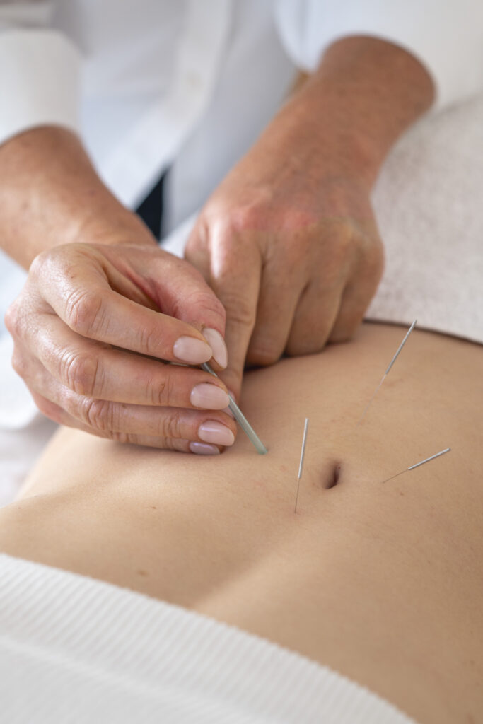 Akupunktur