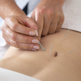 Akupunktur